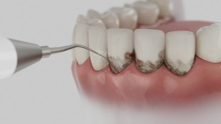 Trusted Teeth Cleaning And Checkup service in Lake Mohawk, OH - Dentist Open Now